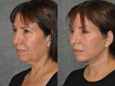 AuraLyft with Eyelid Rejuvenation- Left Side