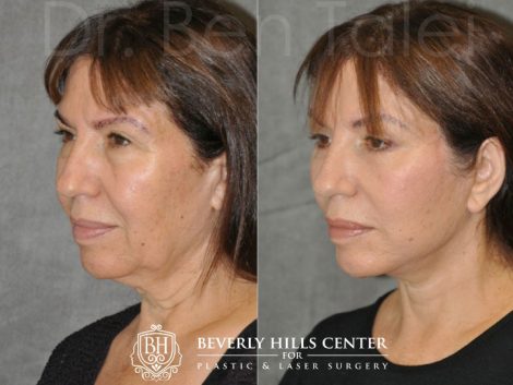 AuraLyft with Eyelid Rejuvenation- Left Side