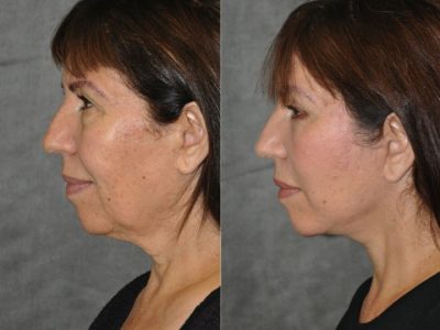 AuraLyft with Eyelid Rejuvenation - Left Side