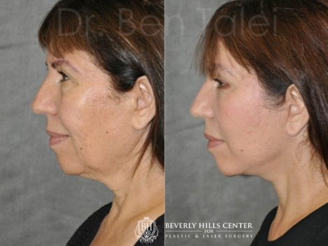AuraLyft with Eyelid Rejuvenation - Left Side