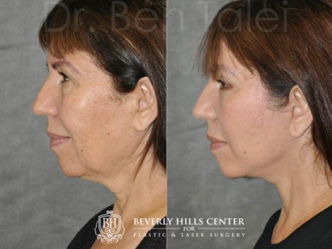 AuraLyft with Eyelid Rejuvenation- Left Side