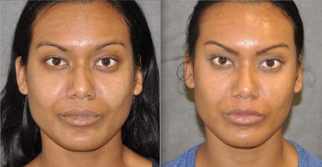 Profound MicroLift with Tri-L Treatment – Front