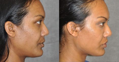 Profound MicroLift with Tri-L Treatment – Right Side