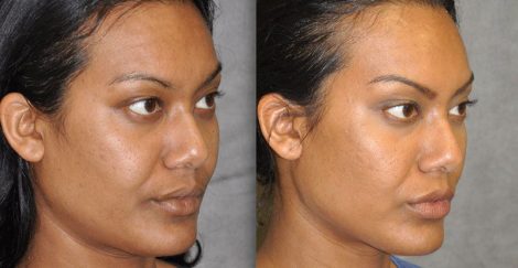 Profound MicroLift with Tri-L Treatment - Right Side