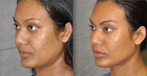 Profound MicroLift with Tri-L Treatment – Left Side