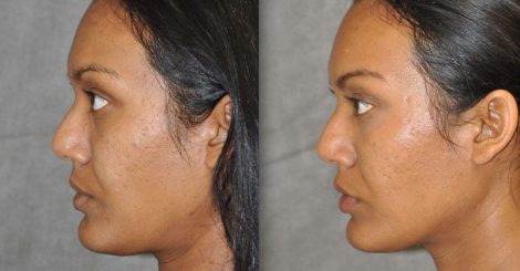 Profound MicroLift with Tri-L Treatment – Left Side