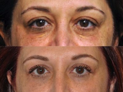 Xanthelasma Excision, Upper Eyelid and Lower Eyelid Tightening with Fat Transposition. - Front