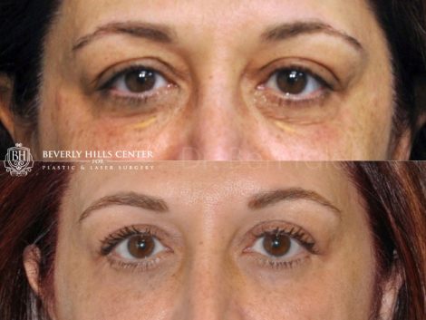Xanthelasma Excision, Upper Eyelid and Lower Eyelid Tightening with Fat Transposition. - Front