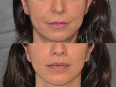 Modified Upper Lip Lift - Front