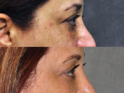 Xanthelasma Excision, Upper Eyelid and Lower Eyelid Tightening with Fat Transposition. - Right Side