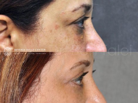 Xanthelasma Excision, Upper Eyelid and Lower Eyelid Tightening with Fat Transposition. - Right Side