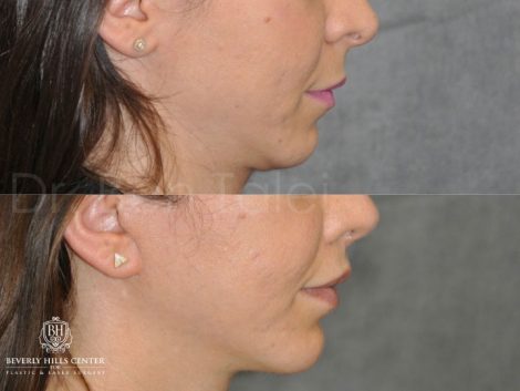 Beverly Hills Center Female Patient Before and After Small Chin Implant Procedure