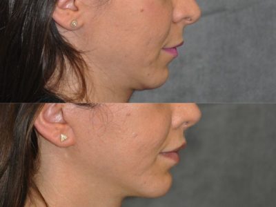 Modified Upper Lip Lift - Right Side