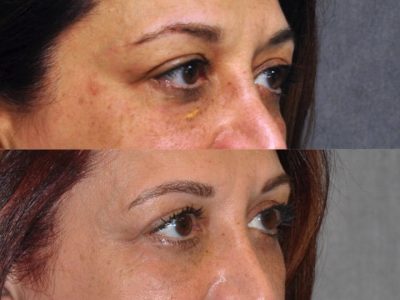 Xanthelasma Excision, Upper Eyelid and Lower Eyelid Tightening with Fat Transposition. - Right Side
