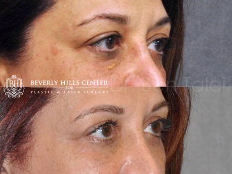 Xanthelasma Excision, Upper Eyelid and Lower Eyelid Tightening with Fat Transposition. - Right Side