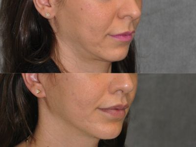 Modified Upper Lip Lift - Right Side