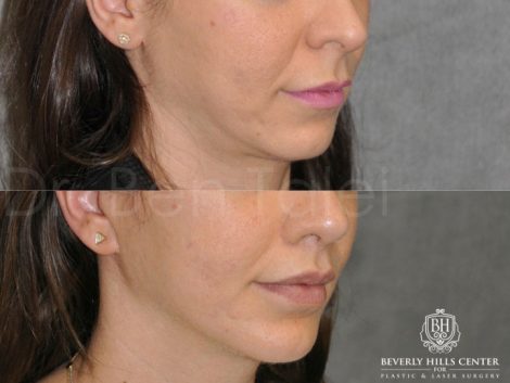 Modified Upper Lip Lift - Right Side