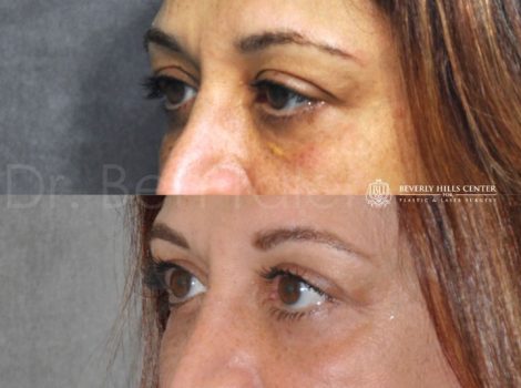 Xanthelasma Excision, Upper Eyelid and Lower Eyelid Tightening with Fat Transposition. - Left Side