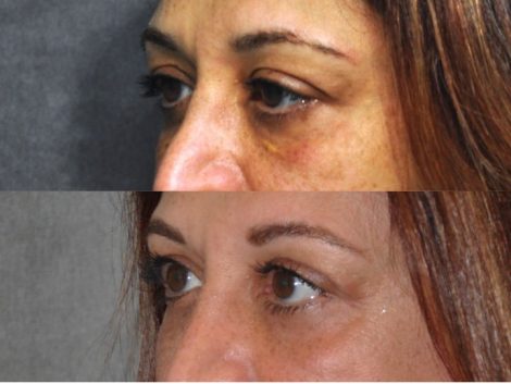 Xanthelasma Excision, Upper Eyelid and Lower Eyelid Tightening with Fat Transposition. - Left Side