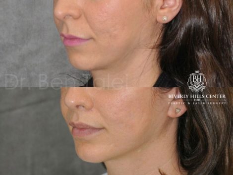 Beverly Hills Center Female Patient Before and After Small Chin Implant Procedure