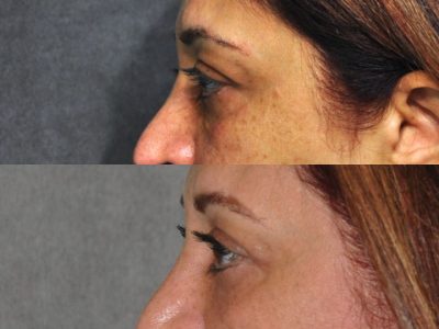 Xanthelasma Excision, Upper Eyelid and Lower Eyelid Tightening with Fat Transposition. - Left Side