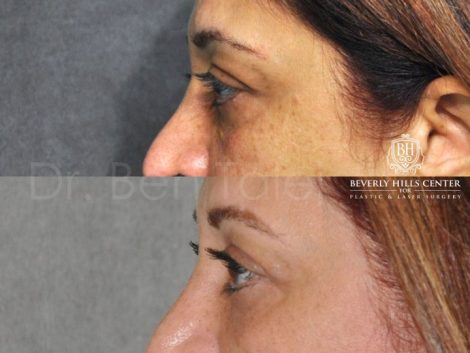 Xanthelasma Excision, Upper Eyelid and Lower Eyelid Tightening with Fat Transposition. - Left Side