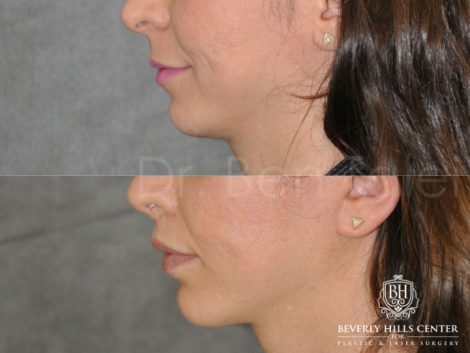 Beverly Hills Center Female Patient Before and After Small Chin Implant Procedure