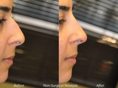 Non Surgical Rhinoplasty / Liquid NoseJob