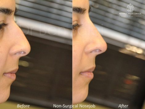 Non Surgical Rhinoplasty / Liquid NoseJob