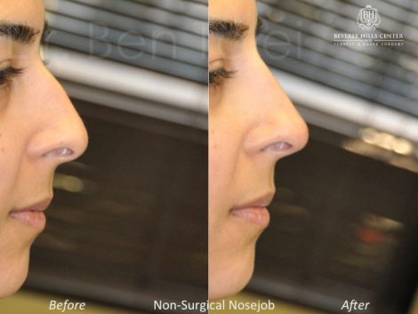 Non Surgical Rhinoplasty / Liquid NoseJob