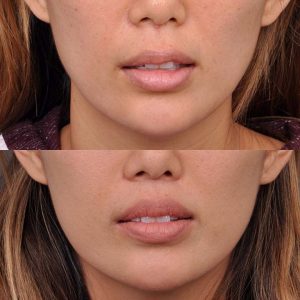 Modified Upper Lip Lift - Front