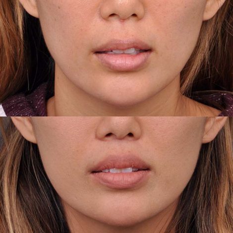 Modified Upper Lip Lift - Front