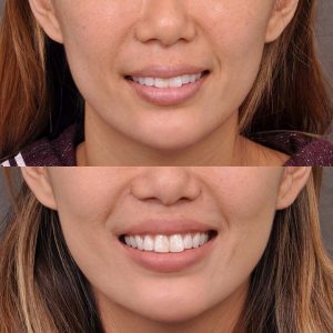 Modified Upper Lip Lift - Front