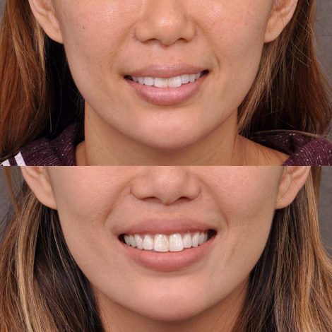 Modified Upper Lip Lift - Front
