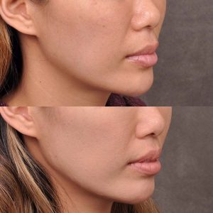 Modified Upper Lip Lift - Right Side