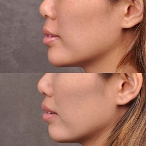 Modified Upper Lip Lift - Left Side