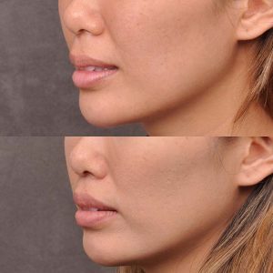 Modified Upper Lip Lift - Left Side