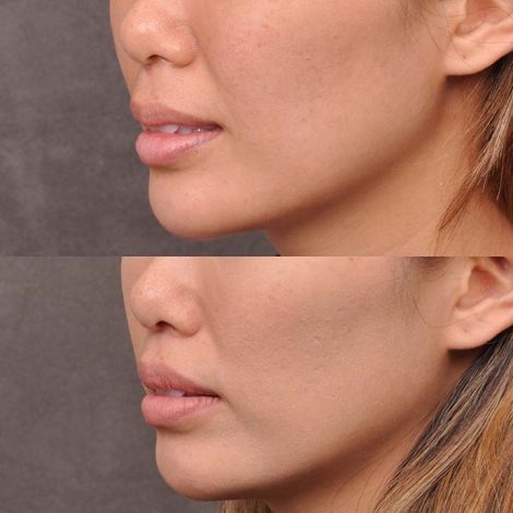 Modified Upper Lip Lift - Left Side
