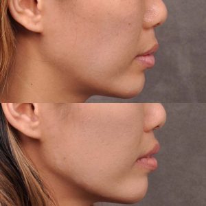 Modified Upper Lip Lift - Right Side