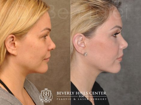 Beverly Hills Center Female Patient Before and After Profound RF treatment