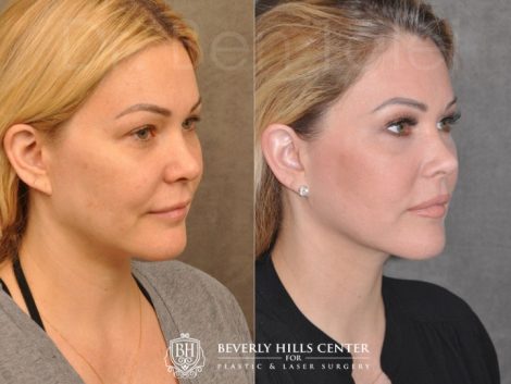 Beverly Hills Center Female Patient Before and After Profound RF treatment