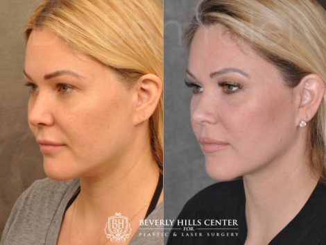 Beverly Hills Center Female Patient Before and After Profound RF treatment