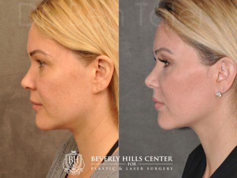 Beverly Hills Center Female Patient Before and After Profound RF treatment