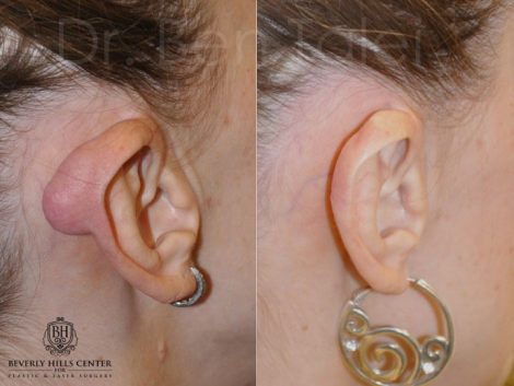Beverly Hills Center Female Patient Before and After Ear Keloid Removal