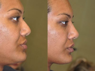 Non Surgical Rhinoplasty / Liquid NoseJob