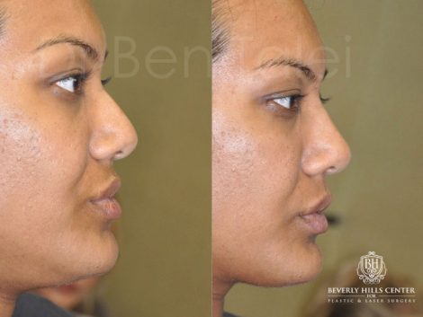 Non Surgical Rhinoplasty / Liquid NoseJob