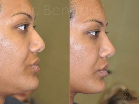 Non Surgical Rhinoplasty / Liquid NoseJob