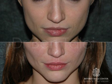 Lip Enhancement - Front