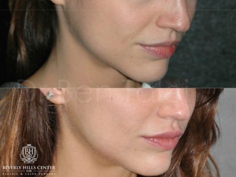 Lip Enhancement - Right Side