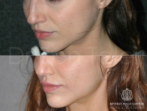 Lip Enhancement - Left Side